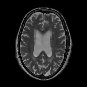slice thickness 3mm SNR high image slice thickness 3mm SNR high image