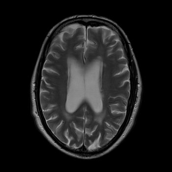 slice thickness 5mm SNR high image slice thickness 5mm SNR high image