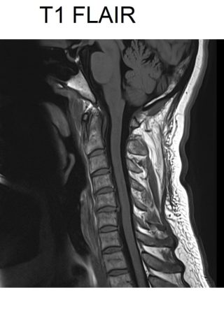 T1 flair image spinal cord T1 flair image spinal cord