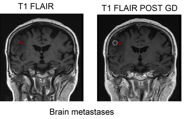 T1 flair pre and post contrast 3t image brain metastases T1 flair pre and post contrast 3t image brain metastases